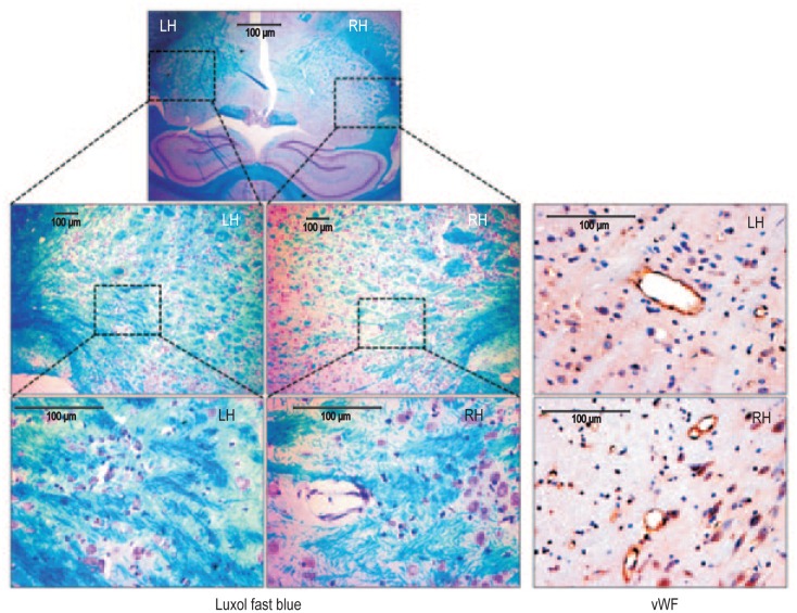 Subcurative radiation significantly increases cell proliferation, invasion, and migration of primary glioblastoma multiforme in vivo.