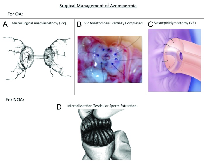 Review of Azoospermia.