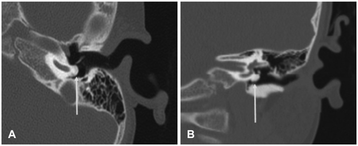 Osteoma of the promontory mimicking a congenital cholesteatoma.