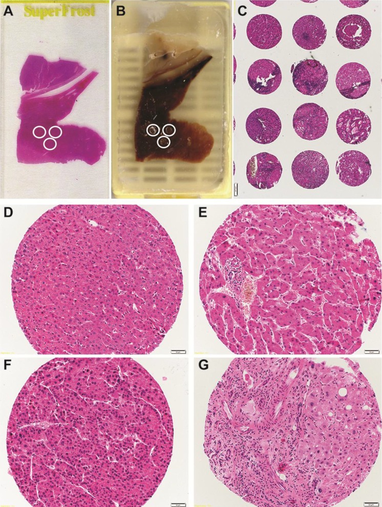 Identification of New Players in Hepatocarcinogenesis: Limits and Opportunities of Using Tissue Microarray (TMA).