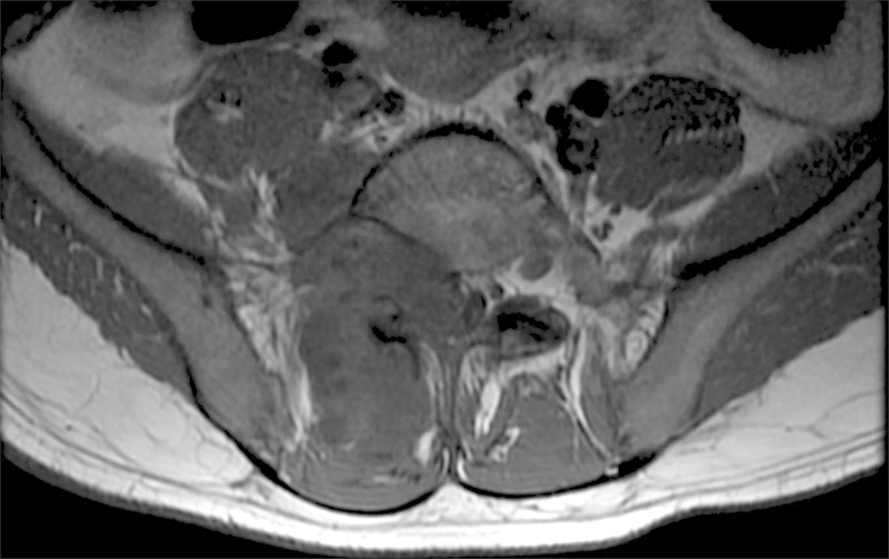 A case of tophaceous gout in the lumbar spine: a review of the literature and treatment recommendations.