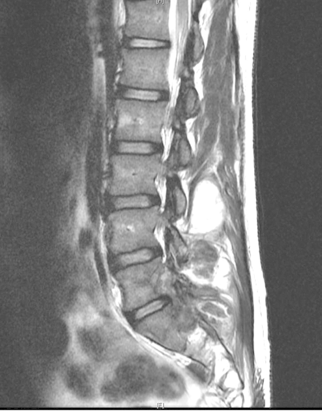 A case of tophaceous gout in the lumbar spine: a review of the literature and treatment recommendations.