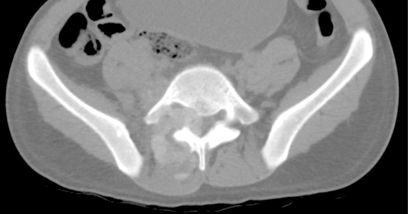 A case of tophaceous gout in the lumbar spine: a review of the literature and treatment recommendations.