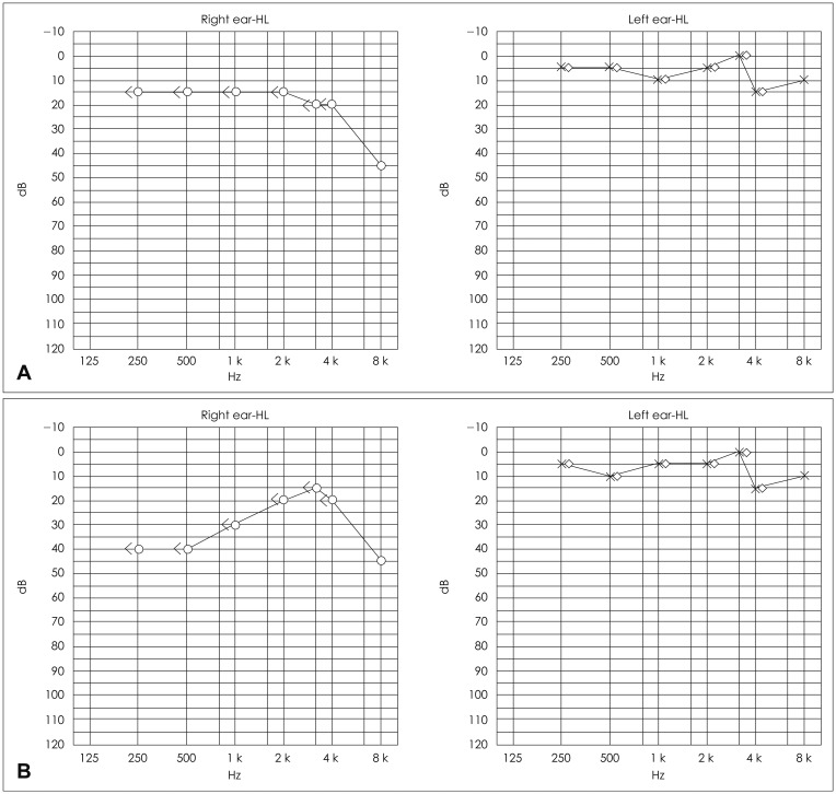 A Case of Post-Traumatic Meniere's Disease.
