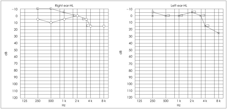 A Case of Post-Traumatic Meniere's Disease.