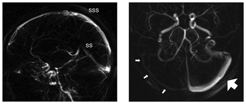 Stent-Mediated Redistribution of Cerebral Venous Outflow in the Treatment of Severe Intractable Headache: A Case Report.