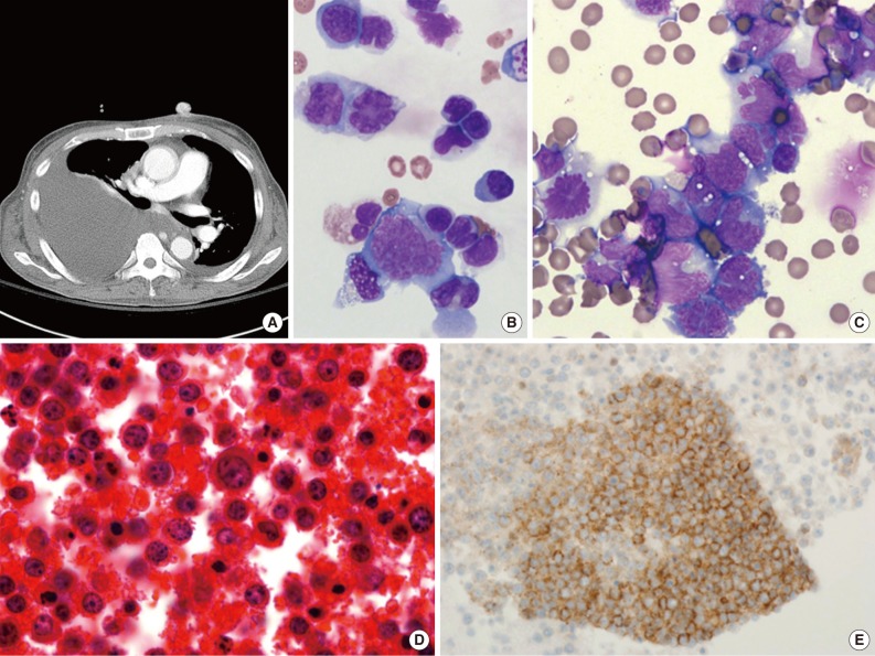 Current concepts in primary effusion lymphoma and other effusion-based lymphomas.