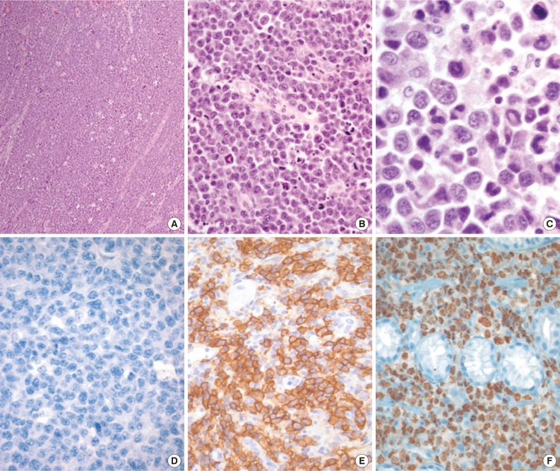 Current concepts in primary effusion lymphoma and other effusion-based lymphomas.