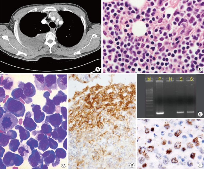 Current concepts in primary effusion lymphoma and other effusion-based lymphomas.