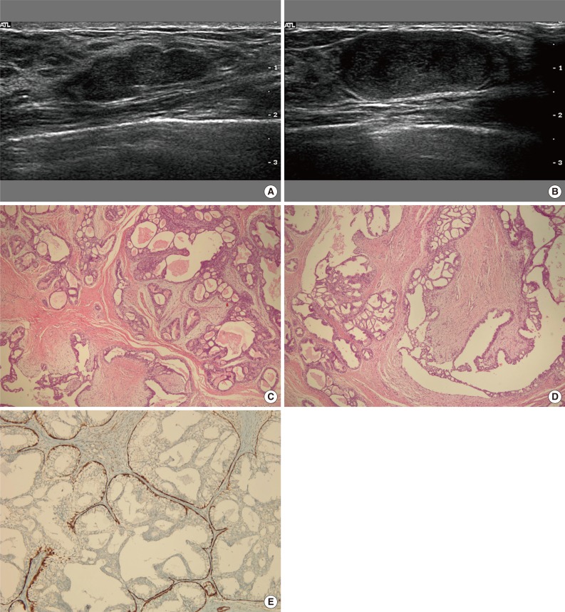 Simultaneous Occurrence of Ductal Carcinoma In Situ within Juvenile Fibroadenoma in Both Breasts: A Brief Case Report.