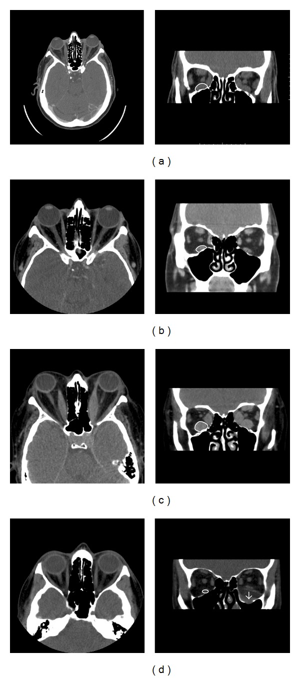 Orbital Volumetry in Graves' Orbitopathy: Muscle and Fat Involvement in relation to Dysthyroid Optic Neuropathy.