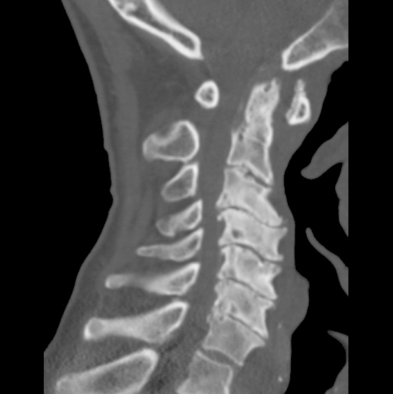 Vertebral artery anomaly and injury in spinal surgery.