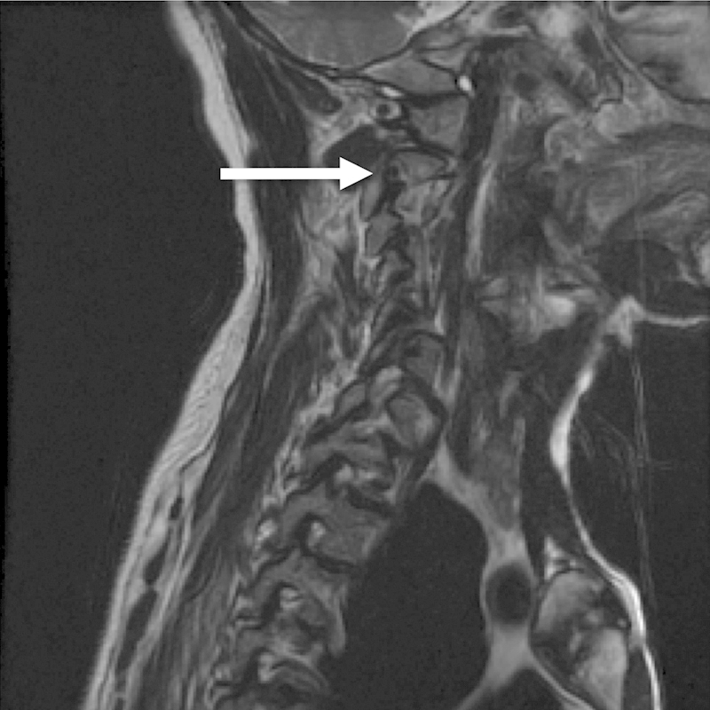 Vertebral artery anomaly and injury in spinal surgery.