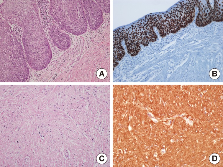 Esophageal squamous cell carcinoma in situ overlying leiomyoma mimicking invasive cancer: a brief case report.