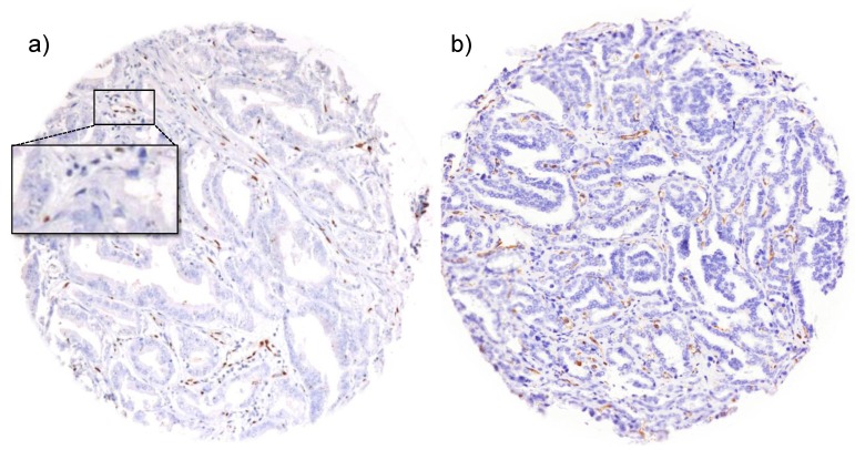 Qualitative and Quantitative Requirements for Assessing Prognostic Markers in Prostate Cancer.