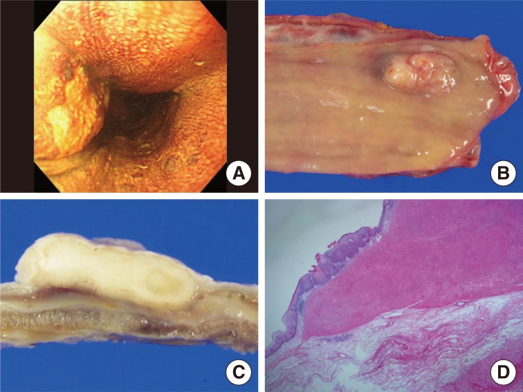 Esophageal squamous cell carcinoma in situ overlying leiomyoma mimicking invasive cancer: a brief case report.