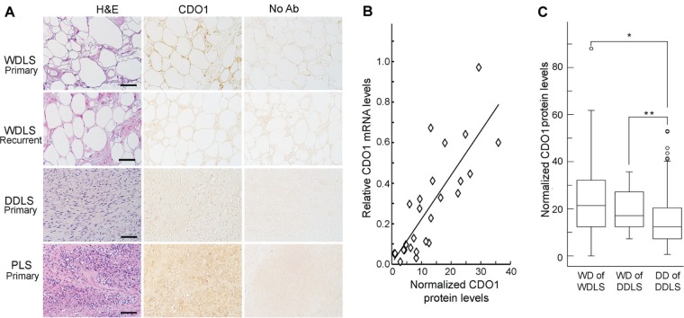 Differential expression of cysteine dioxygenase 1 in complex karyotype liposarcomas.
