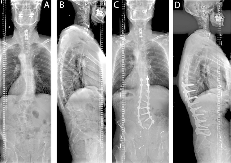 The concomitance of cervical spondylosis and adult thoracolumbar spinal deformity.