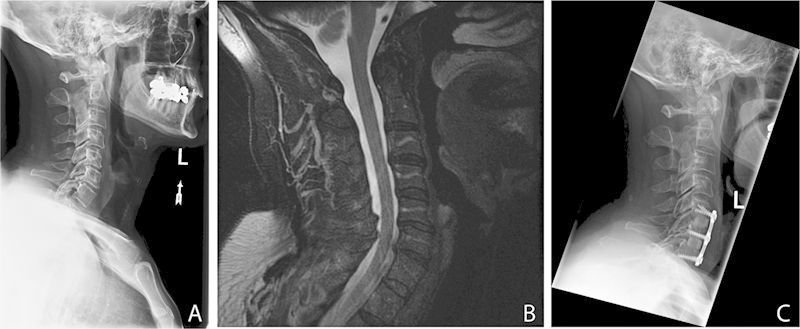 The concomitance of cervical spondylosis and adult thoracolumbar spinal deformity.