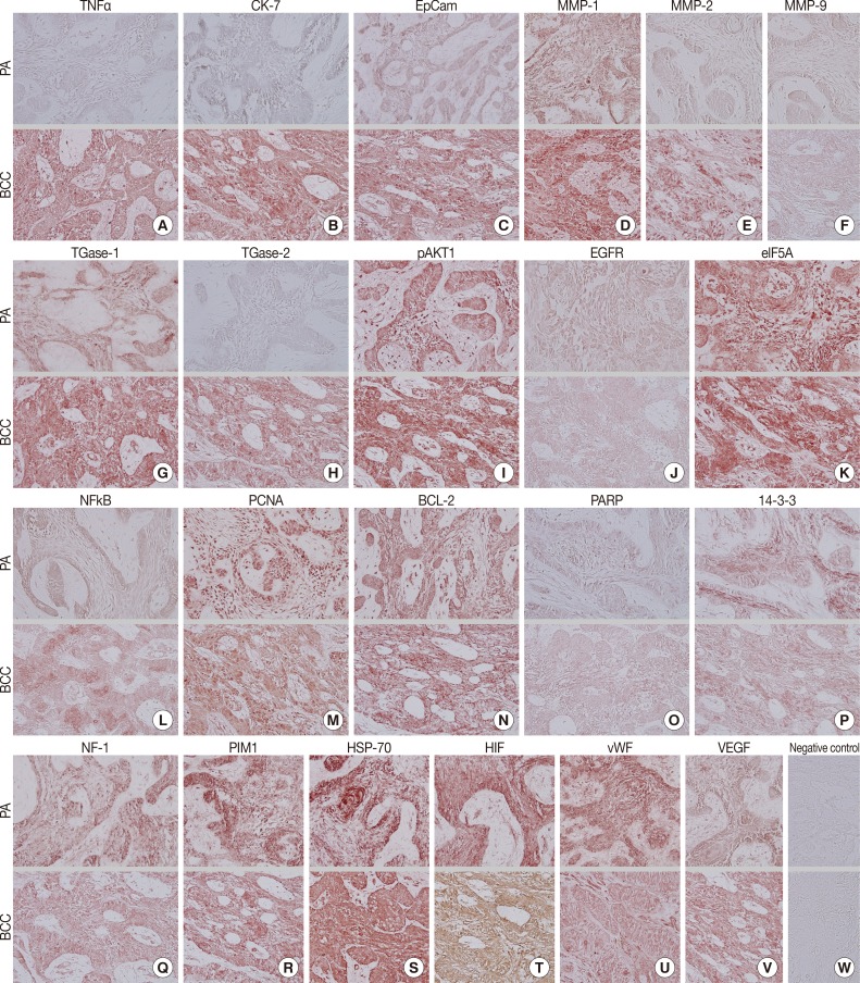 Different Protein Expressions between Peripheral Ameloblastoma and Oral Basal Cell Carcinoma Occurred at the Same Mandibular Molar Area.