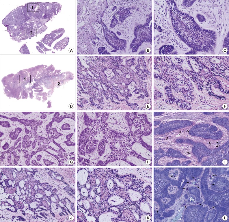 Different Protein Expressions between Peripheral Ameloblastoma and Oral Basal Cell Carcinoma Occurred at the Same Mandibular Molar Area.