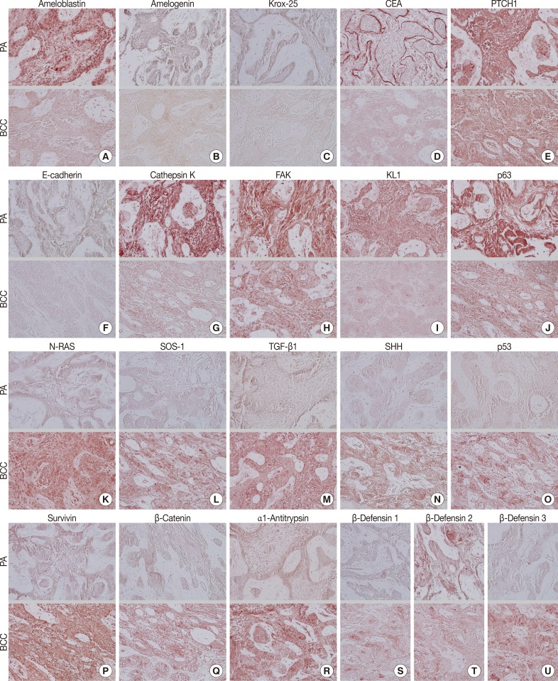 Different Protein Expressions between Peripheral Ameloblastoma and Oral Basal Cell Carcinoma Occurred at the Same Mandibular Molar Area.