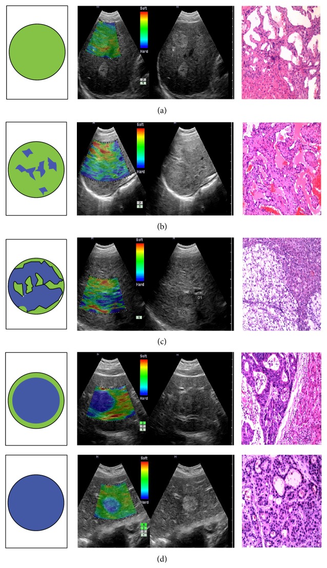 Application of Real-Time Tissue Elastography with a Low Frequency Convex Array Probe: A Noninvasive Approach to Differential Diagnosis of Liver Tumors.