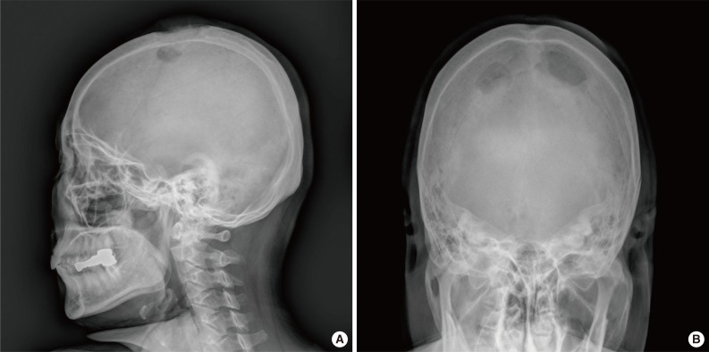 Multifocal osteosarcoma of the skull: multiple primary or metastatic? A case report.