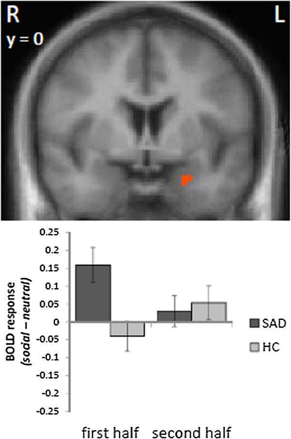Area-dependent time courses of brain activation during video-induced symptom provocation in social anxiety disorder.