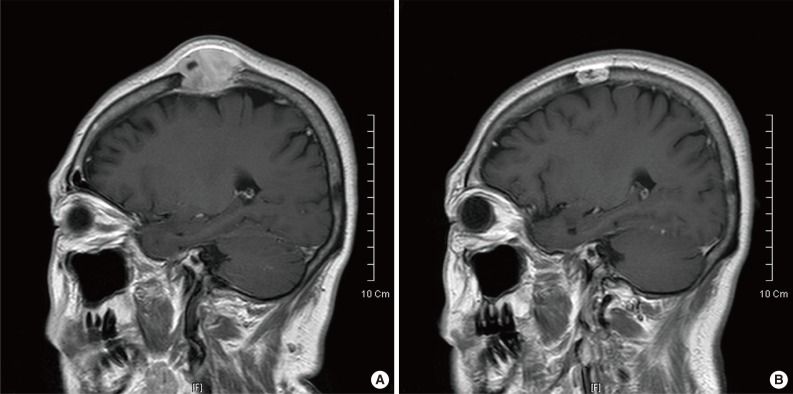 Multifocal osteosarcoma of the skull: multiple primary or metastatic? A case report.