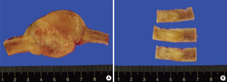 Multifocal osteosarcoma of the skull: multiple primary or metastatic? A case report.