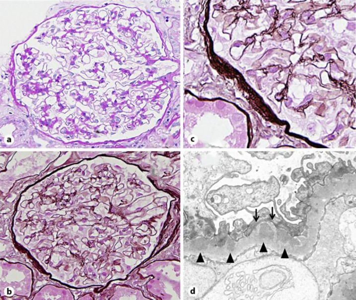 A Case of Membranous Glomerulonephropathy Associated with Takayasu's Arteritis.