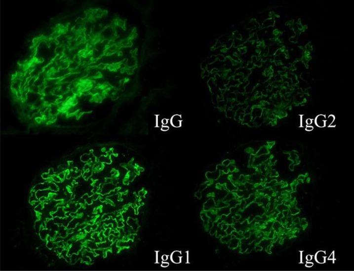 A Case of Membranous Glomerulonephropathy Associated with Takayasu's Arteritis.