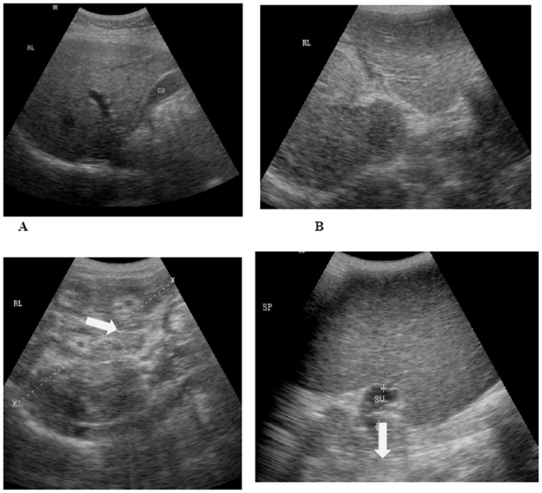 Utility of Diagnostic Imaging in the Diagnosis and Management of Schistosomiasis.