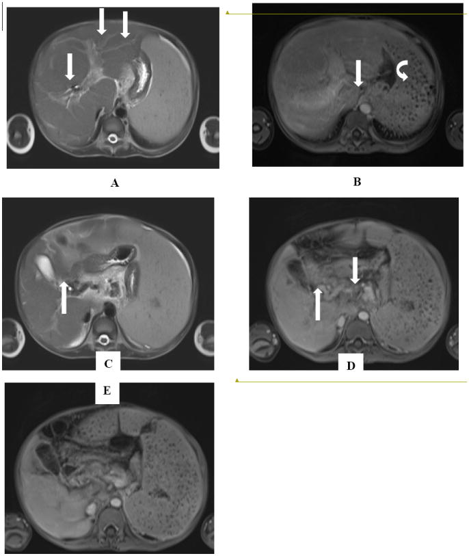 Utility of Diagnostic Imaging in the Diagnosis and Management of Schistosomiasis.