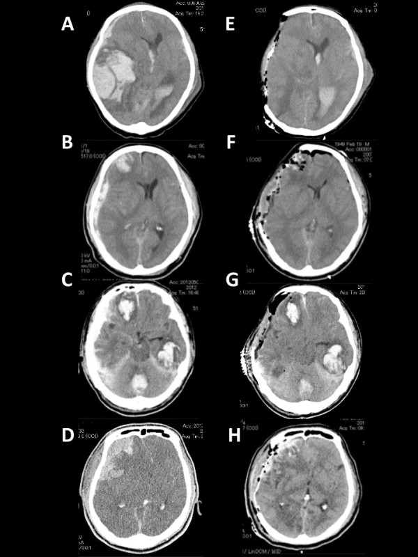 Hemispheric differences in the surgical outcomes of patients with traumatic acute subdural hematoma.