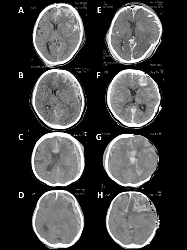 Hemispheric differences in the surgical outcomes of patients with traumatic acute subdural hematoma.