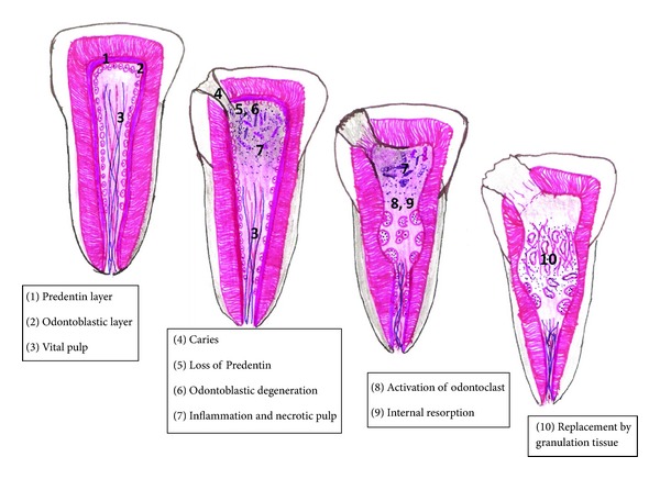 An insight into internal resorption.