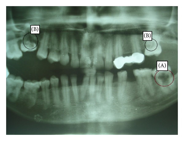 An insight into internal resorption.