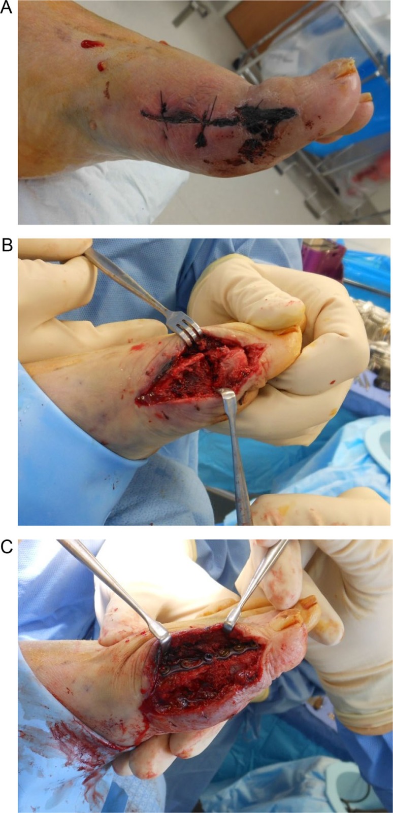 Complication rates in diabetics with first metatarsophalangeal joint arthrodesis.