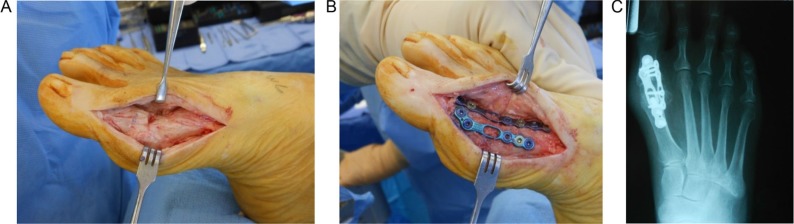 Complication rates in diabetics with first metatarsophalangeal joint arthrodesis.