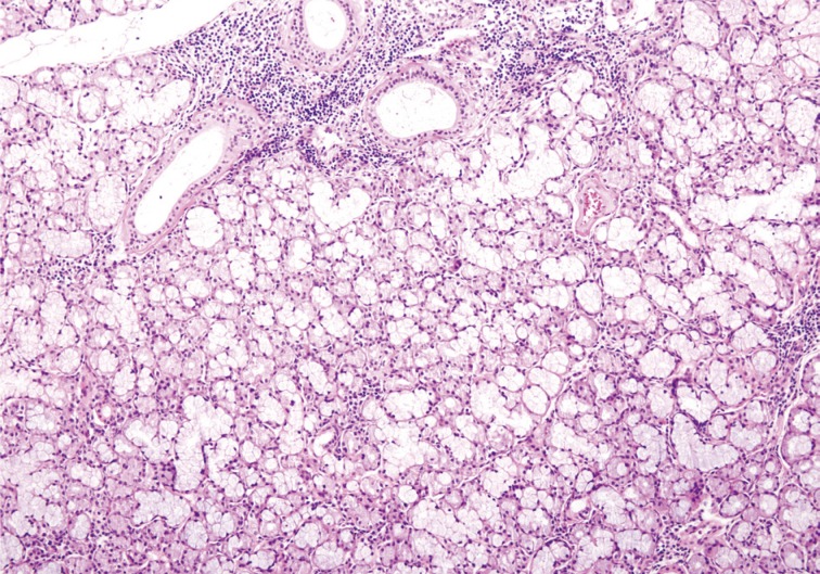 Bilateral stafne bone cavity in the anterior mandible with heterotopic salivary gland tissue: a case report.