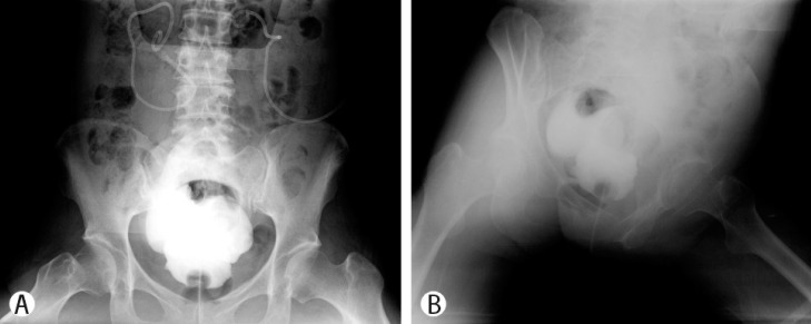 A Case of Post-radiotherapy Urethral Stricture with Spontaneous Bladder Rupture, Mimicking Obstructive Uropathy due to Cancer Metastasis.