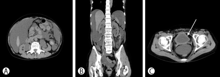 A Case of Post-radiotherapy Urethral Stricture with Spontaneous Bladder Rupture, Mimicking Obstructive Uropathy due to Cancer Metastasis.