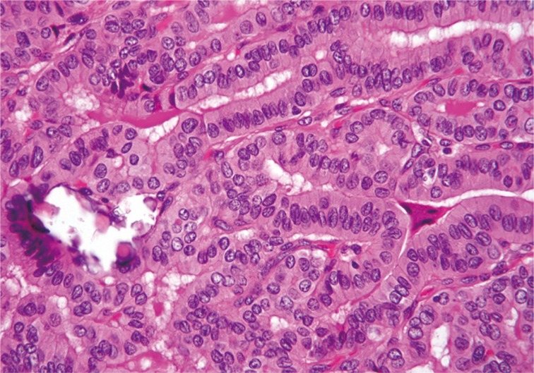 Classic papillary thyroid carcinoma with tall cell features and tall cell variant have similar clinicopathologic features.