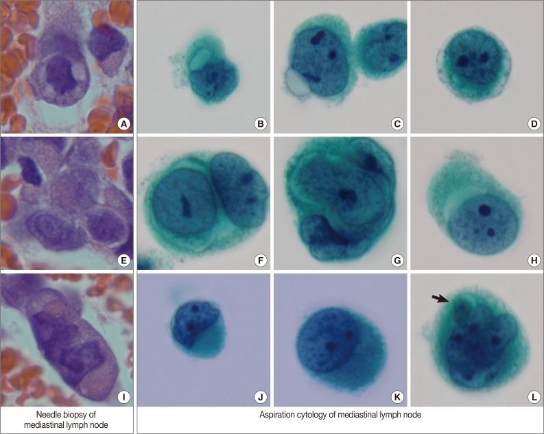 A case of metastatic angiosarcoma diagnosed by liquid-based preparation: peculiar cytoplasmic changes.