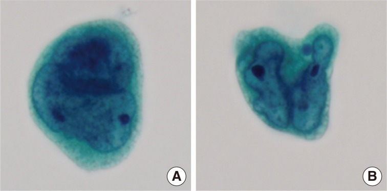 A case of metastatic angiosarcoma diagnosed by liquid-based preparation: peculiar cytoplasmic changes.