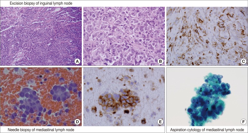 A case of metastatic angiosarcoma diagnosed by liquid-based preparation: peculiar cytoplasmic changes.