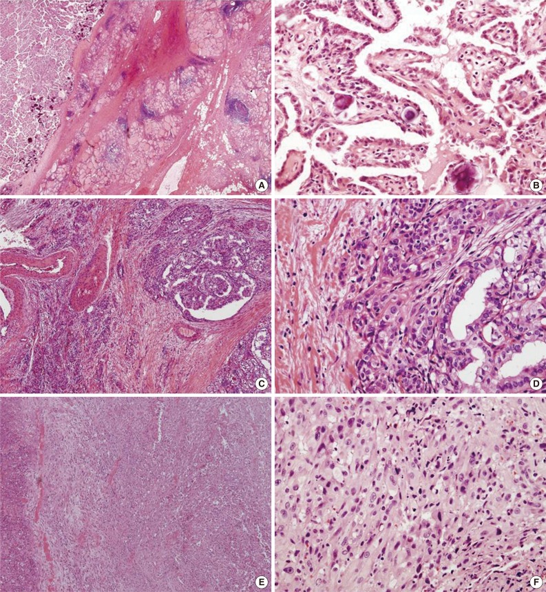 Anaplastic Transformation of Papillary Thyroid Carcinoma in a Young Man: A Case Study with Immunohistochemical and BRAF Analysis.