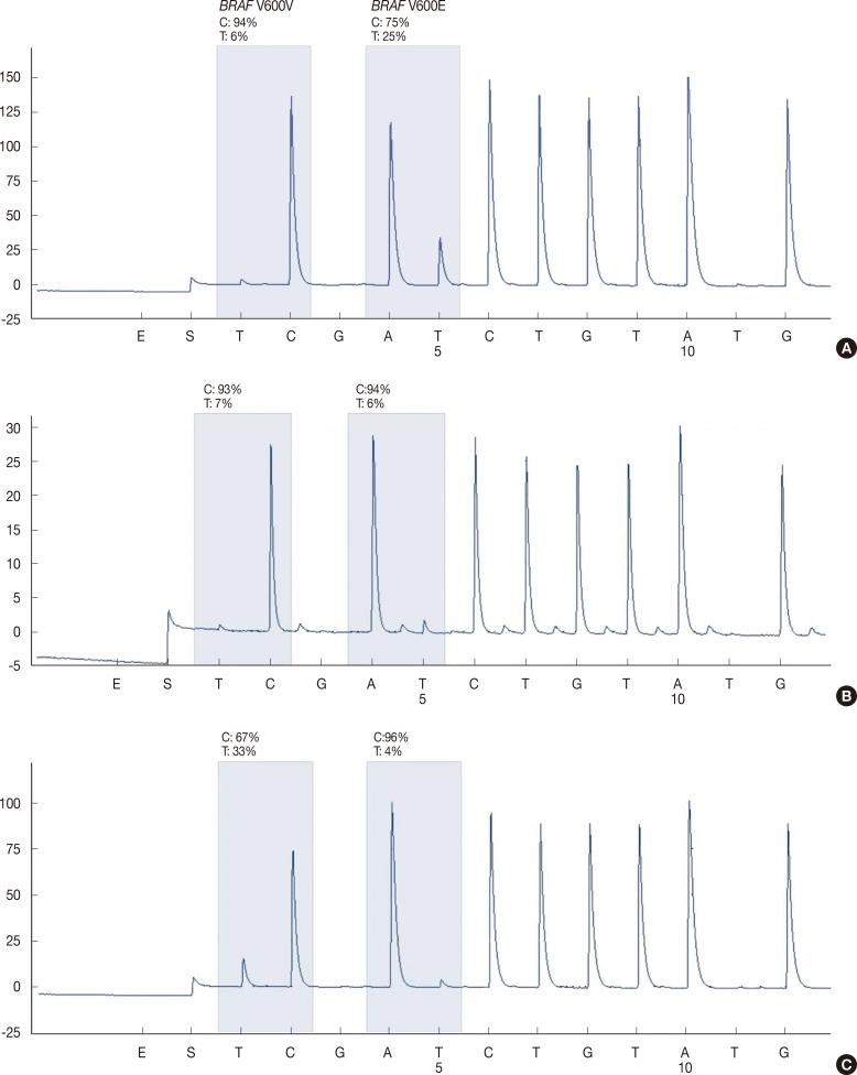 Anaplastic Transformation of Papillary Thyroid Carcinoma in a Young Man: A Case Study with Immunohistochemical and BRAF Analysis.